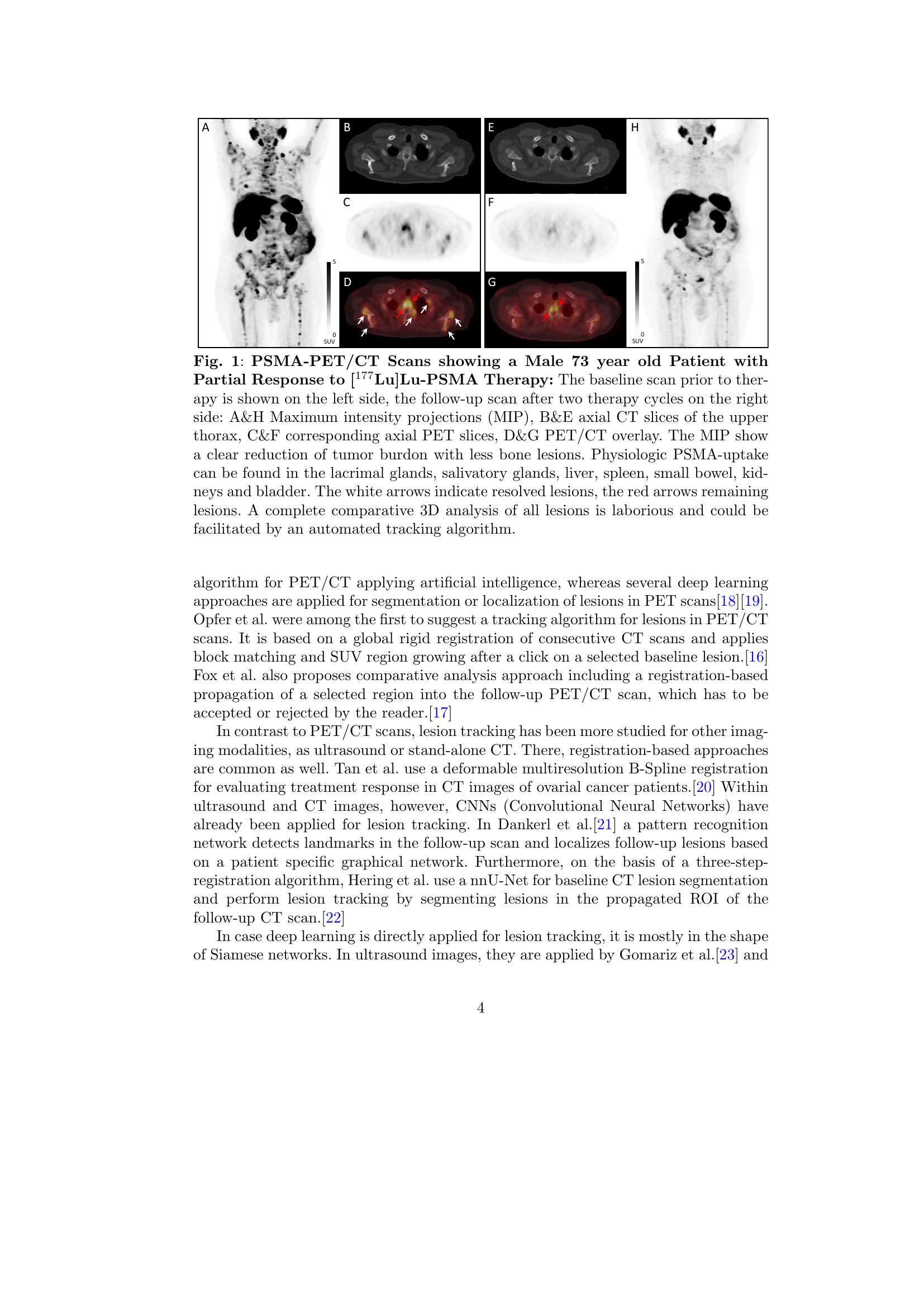 Towards AI Lesion Tracking in PET/CT Imaging: A Siamese-based CNN ...